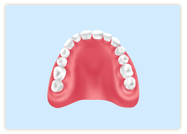 レジン床義歯（保険の入れ歯）