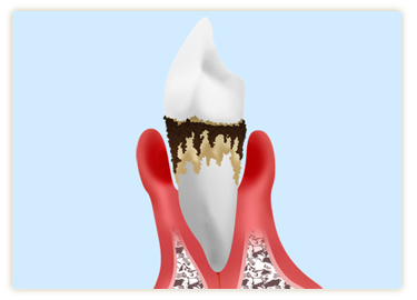 成人の8割が歯周病または歯周病予備軍です～歯周病～